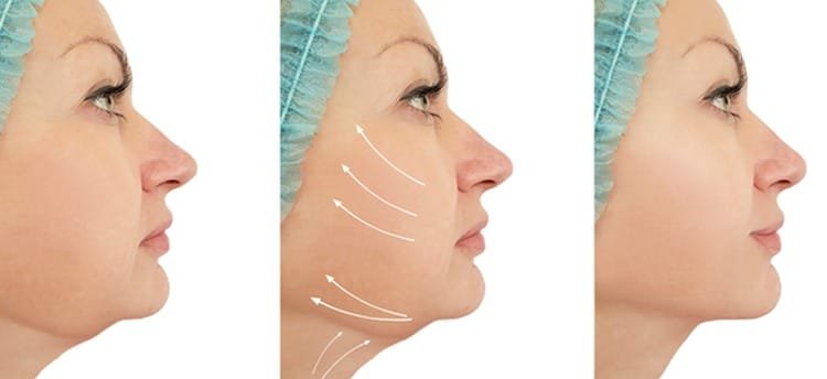 liposuccion visage Tunisie